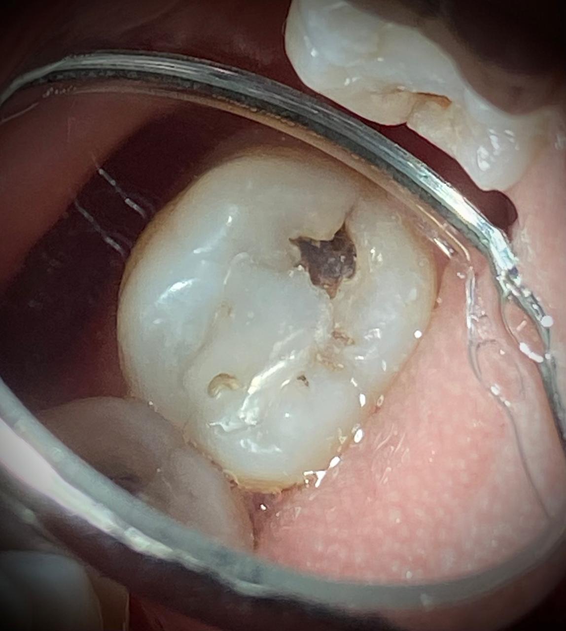 Remoção de cáries profundas sem a necessidade de tratamento de canal