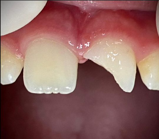 Restauração de dentes fraturados